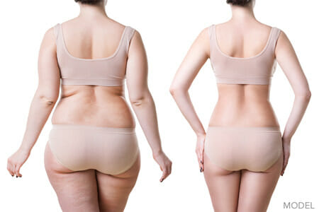 Body Lift Surgery Montclair New Jersey
