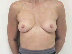 Before Breast Implants