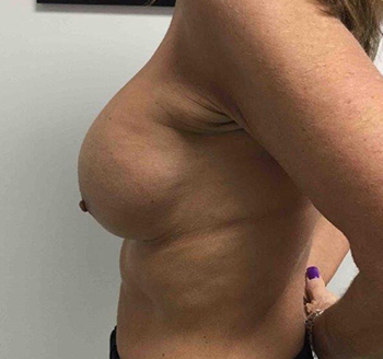 Before Breast Implants