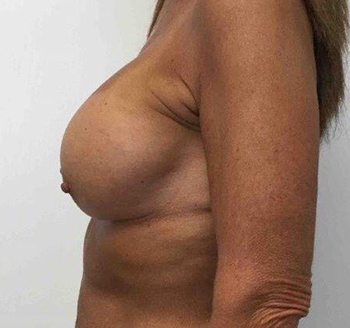 After Breast Implants